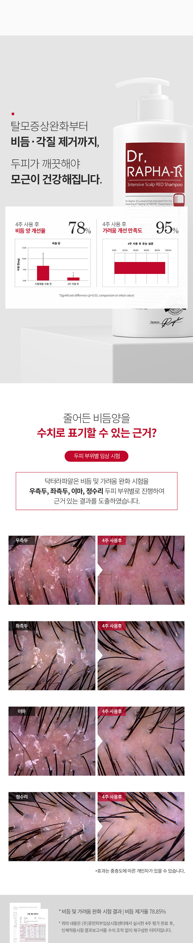 [닥터라파알] 레드 탈모 샴푸 1L + 단백질 트리트먼트 1L 부드러운 모발 손상모 90.8% 개선 상세 이미지 5